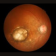 Macular Problems